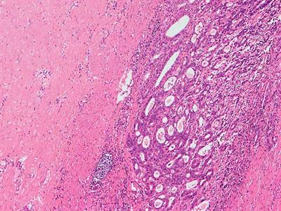 Case report: A case of delayed cutaneous metastases from signet-ring cell mixed-type gastric cancer